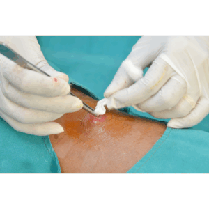 Abscess Drainage
